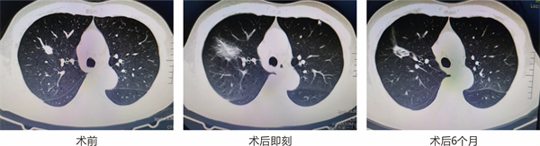 微波消融術治療肺結節，半年后復查結節消失了